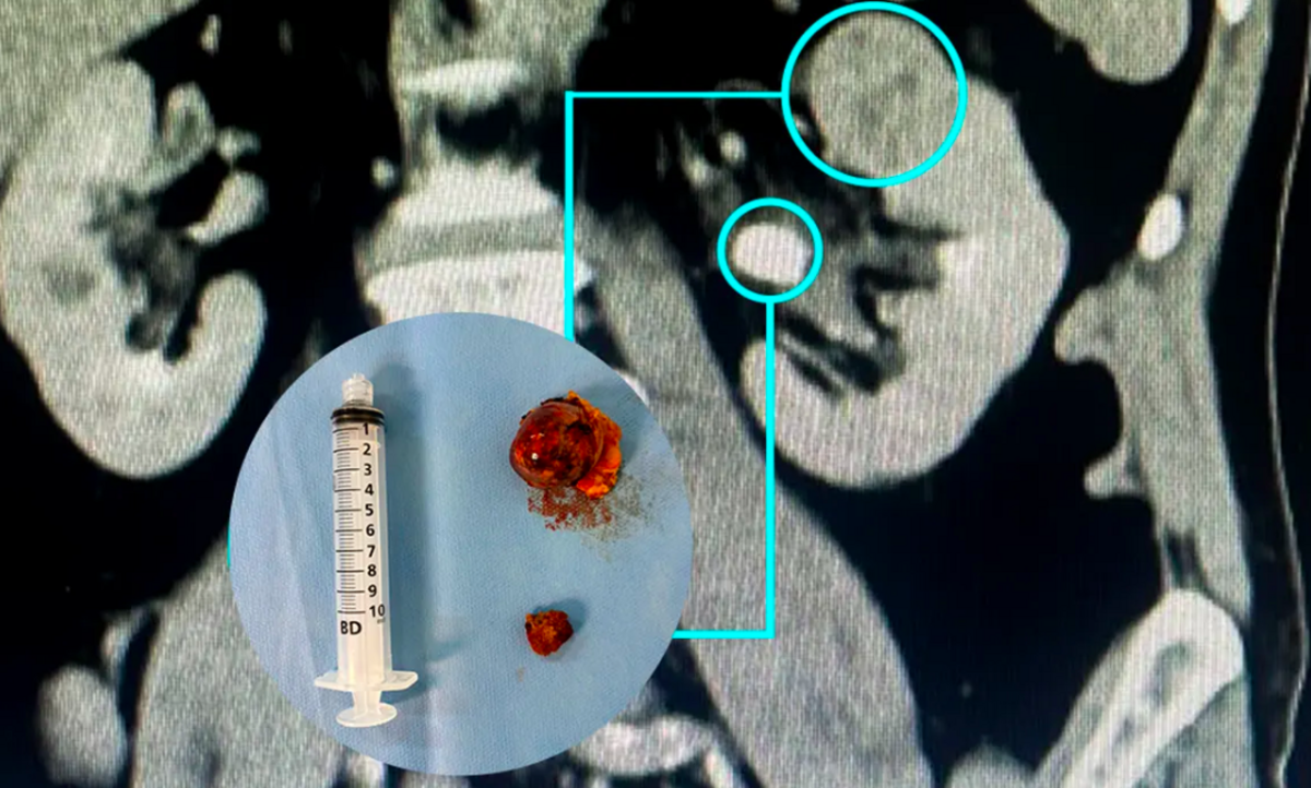 Nefrectomia robótica preserva rins com alta precisão