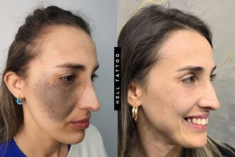 Nevo de Ota pode ser tratado com laser, explica biomédico
