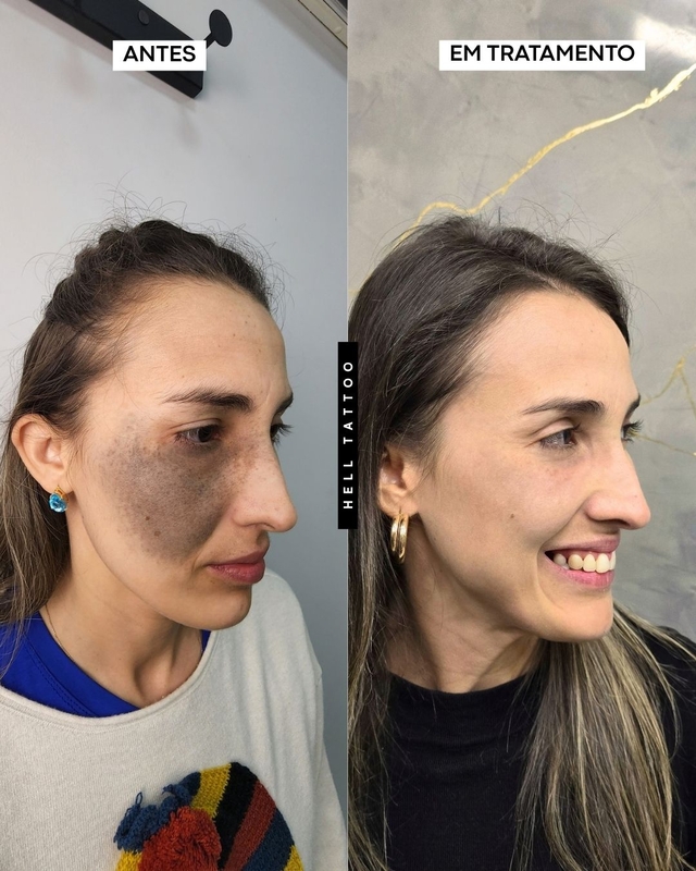 Nevo de Ota pode ser tratado com laser, explica biomédico